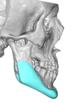 The Significance of the Antegonial Notch in Custom Jawline Implant Designs - Explore Plastic Surgery