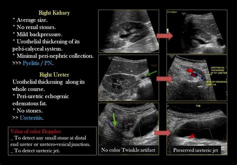 How To See Kidney Stones On Ultrasound - Askworksheet