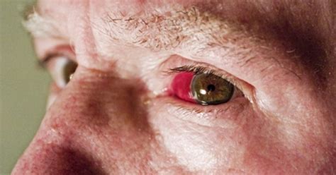 Eye Disorders That Cause Redness in the Corner of the Eye | LIVESTRONG.COM