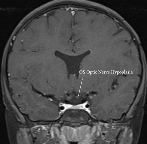 Unilateral Optic Nerve Hypoplasia in a patient desiring surgical treatment for his exotropia