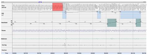 IJERPH | Free Full-Text | First Description of the Hyperpnea–Hypopnea Periodic Breathing in ...