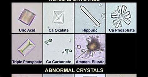 Uric Acid Crystals in Urine - EliezerqoMendez