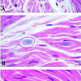 A, Sural nerve biopsy, transverse section. Round polyglucosan body... | Download Scientific Diagram