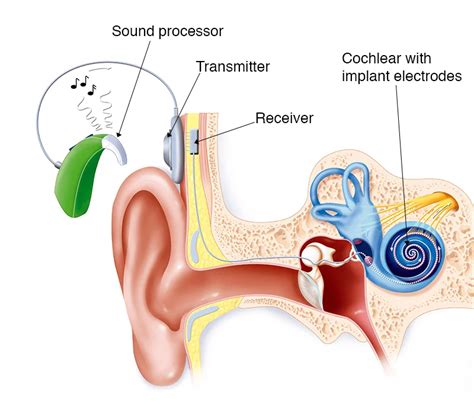 Cochlear Implant - Procedure, Surgery and Benefits