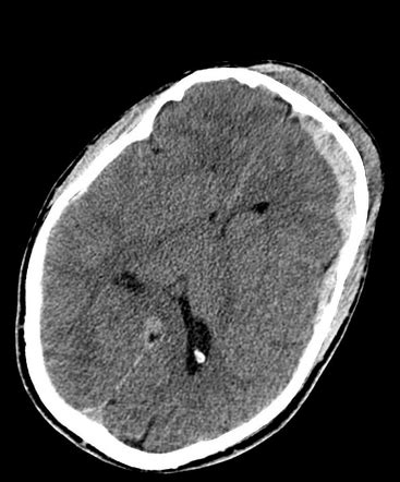 Closed head injury | Radiology Case | Radiopaedia.org