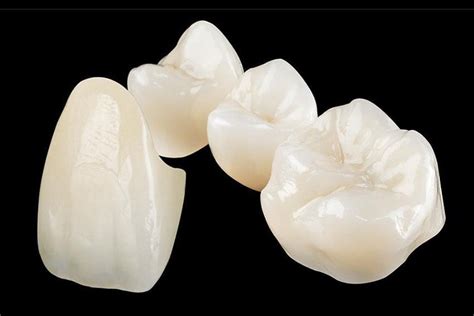 Premium Ceramic Crowns and Onlays - Starlight Dental Clinic