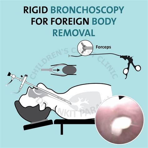 Rigid Bronchoscopy for Children - Dr. Ankit Parakh