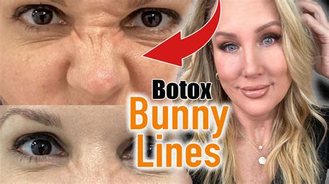 Botox Bunny Lines // Full Tutorial