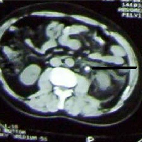 (PDF) Scintigraphic Demonstration of Urine Extravasation Secondary to ...