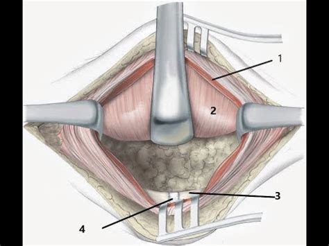 Transverse Pfannenstiel incision. - YouTube