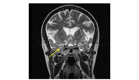 This T2-weighted image shows a subcortical lesion adjacent to the right... | Download Scientific ...