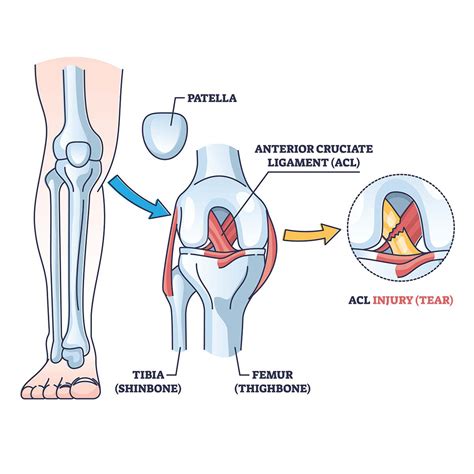 ACL Injury