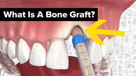 Dental Bone Grafts Explained - YouTube