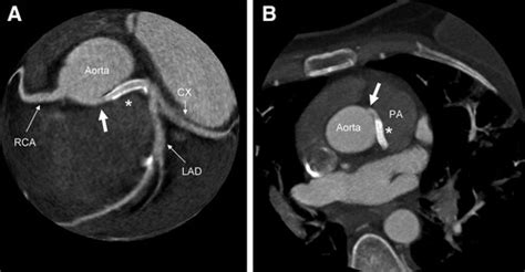 Primary Stenting of an Anomalous Left Main Coronary Artery With an ...