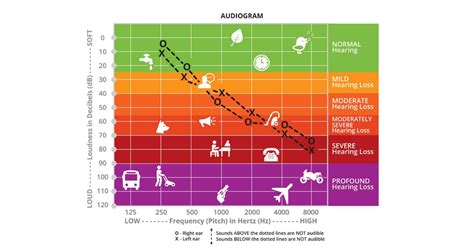 How to live with Mild hearing loss? - Audiology Island