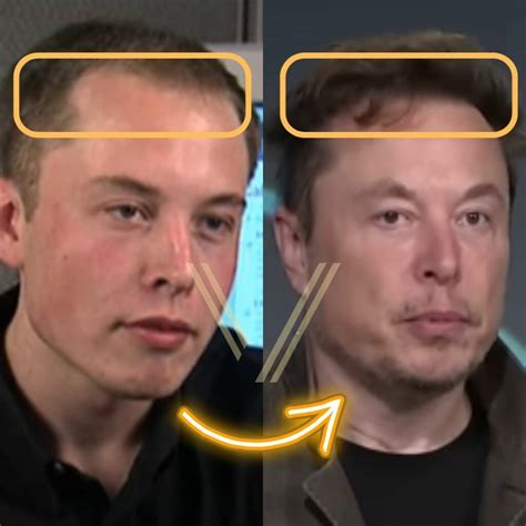 Elon Musk Hair Transplant: Before and After Transformation