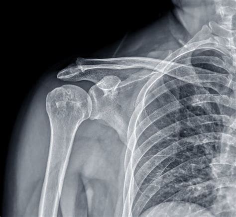 X-ray Shoulder Joint Shoulder Transaxillary View for Diagnosis Fracture of Shoulder Joint Stock ...