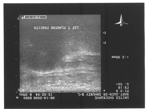 Plantar Fascia Ultrasound