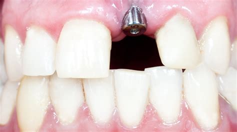 Discover How Dental Implants Improve The Look Of The Mouth | Cosmetic Town