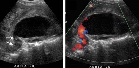 Ultrasound in Abdominal Aortic Aneurysm | IntechOpen