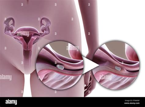 Illustration showing tubal ligation of the Fallopian tube by method of a silicone implant, used ...