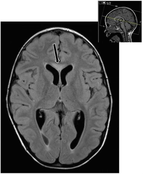 Combined malonic and methylmalonic aciduria, causes, symptoms, diagnosis, treatment & prognosis