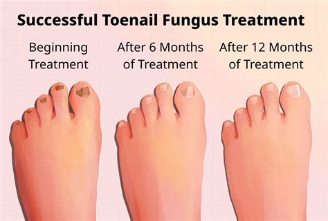 Toe Fungal Medicine Discount USA | gbu-hamovniki.ru