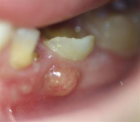 How to Pop a Dental Abscess by Yourself | HubPages