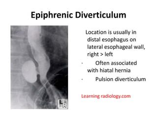 Epiphrenic diverticulum | PPT | Free Download