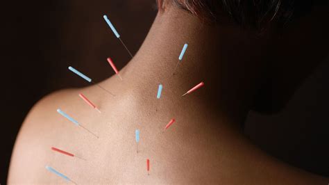 Can Acupuncture Treat Rheumatoid Arthritis? | Everyday Health