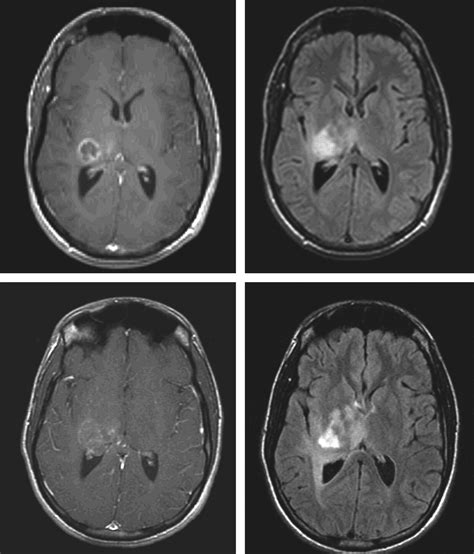 Cat Scan Brain Tumor