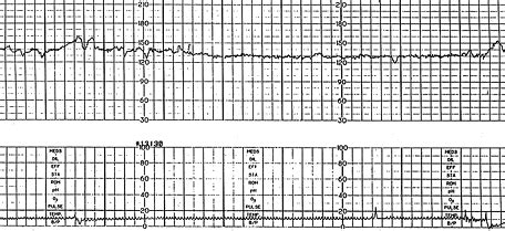 Interpretation of the Electronic Fetal Heart Rate During Labor | AAFP