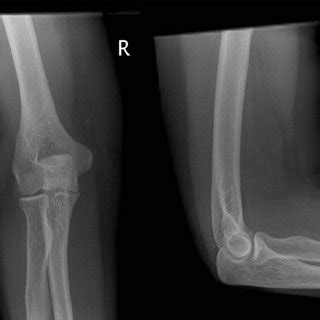 (PDF) Heterotopic calcification