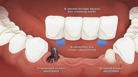 Dental Bridge - Promident Dental