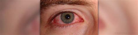 Boric acid as a home remedy for eye infection | Eye Disorders and ...