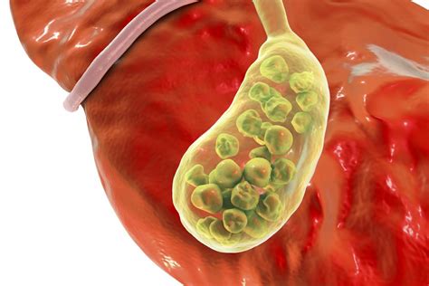 Gallbladder inflammation symptoms: Signs, complications, and causes