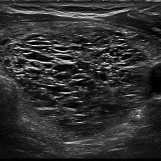 EU-TIRADS 2: spongiform nodule. Transverse plane. | Download Scientific Diagram