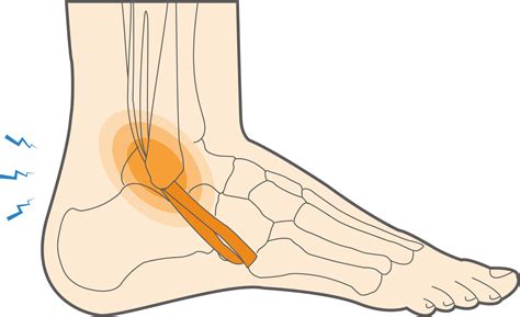 Peroneal Tendonitis Exercises