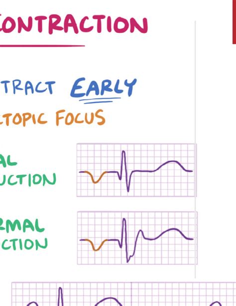 Premature contraction Notes: Diagrams & Illustrations | Osmosis