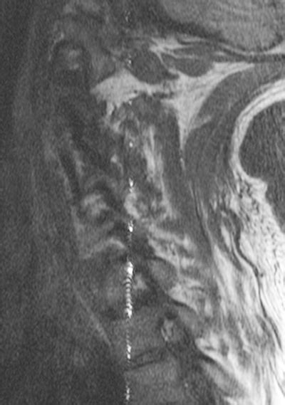 Zipper artifact - Questions and Answers in MRI