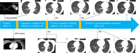 Frontiers | Partial Response After Toripalimab Plus Anlotinib for Advanced Metaplastic Breast ...