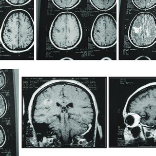 (September 2006) MRI images of the large tumefactive MS lesion, showing... | Download Scientific ...