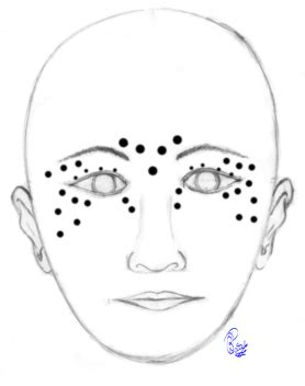 [Figure, Botulinum toxin injections for blepharospasm...] - StatPearls ...