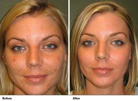 Microdermabrasion Bala Cynwyd | Chemical Peels Philadelphia | Chemical peel, Microdermabrasion ...