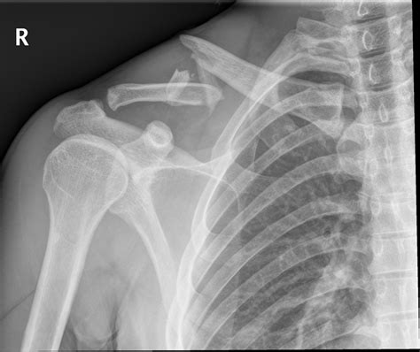 Clavicle fractures : The Shoulder and Elbow Clinic