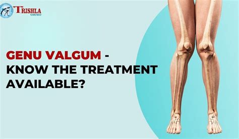 Genu Valgum - Know the Treatment available? - Trishlaortho