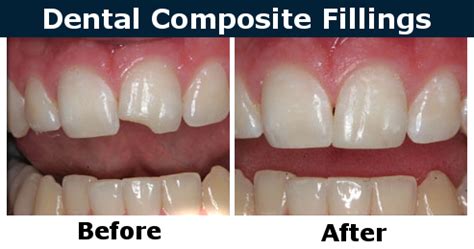 Dental Composite Fillings in Burbank - My Dentist Burbank