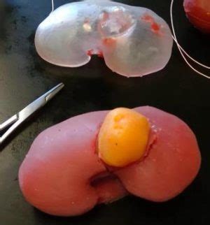 3D Printed Kidney Models Change the Way Surgeons Prepare for Surgery ...