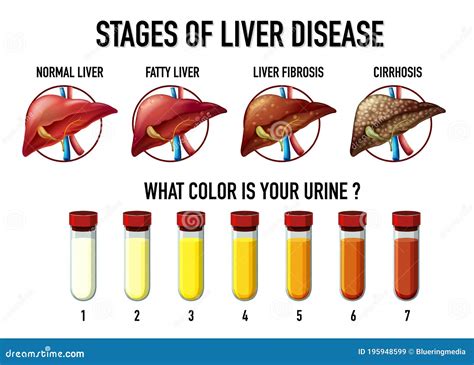 Stages Of Liver Damage. The First Symptoms Of Liver Problems Are Abdominal Pain, Swollen Belly ...