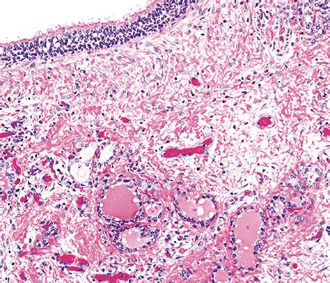 thyroglossal duct cyst pathology